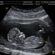 Go Through Ultrasound To Ensure Your Baby Is Healthy